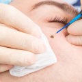 Can Aestheticians Remove Moles? Expert Advice on Mole Removal